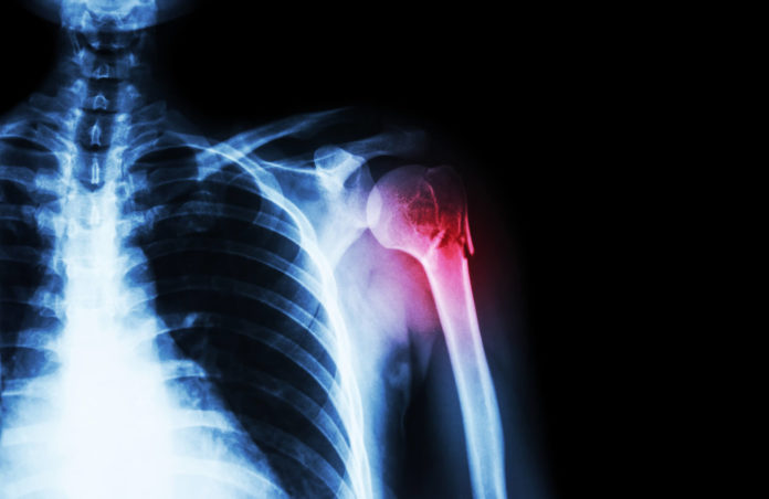 What Happened When I Fell and Broke My Shoulder