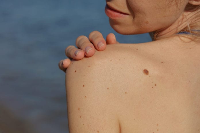 Melanoma: What You Need to Know About Diagnosis and Treatment