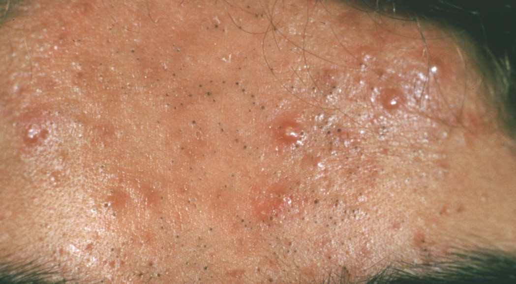 acne science myth
