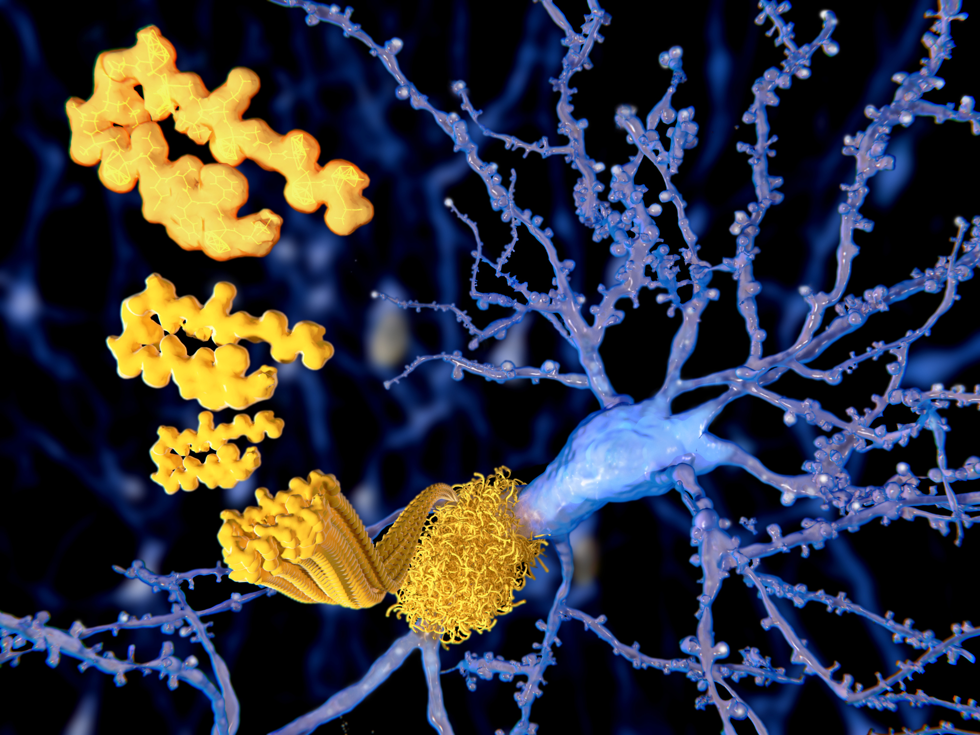 Alzheimers-neurons-plaques-tangles.jpg 2000 x 1500