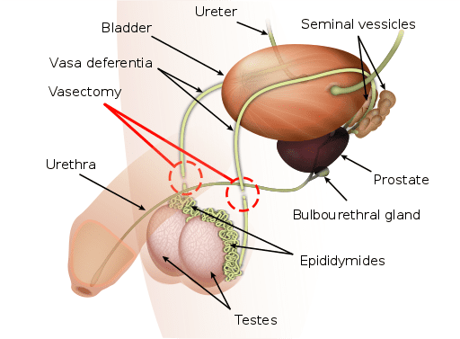 Anatomy of vasectomy 512 x 377 Wikimedia