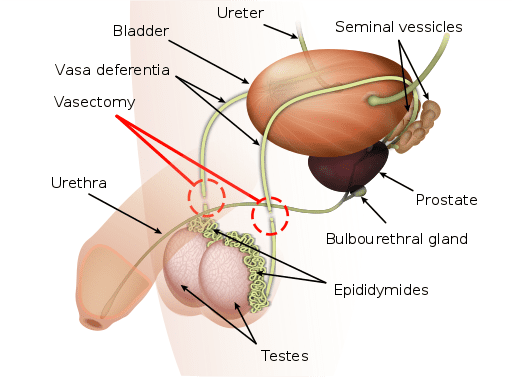 Anatomie der Vasektomie 512 x 377 Wikimedia