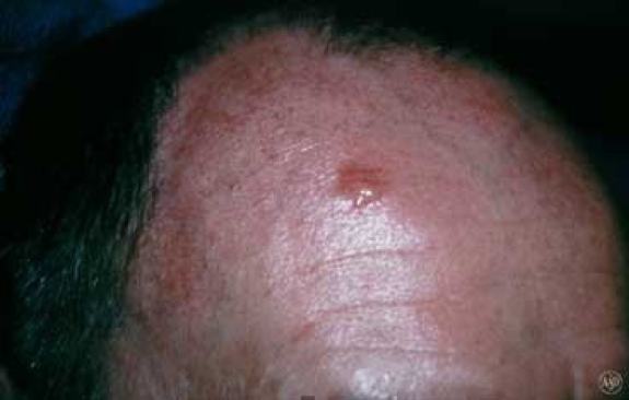 Photo of basal cell carcinoma (575 x 366)