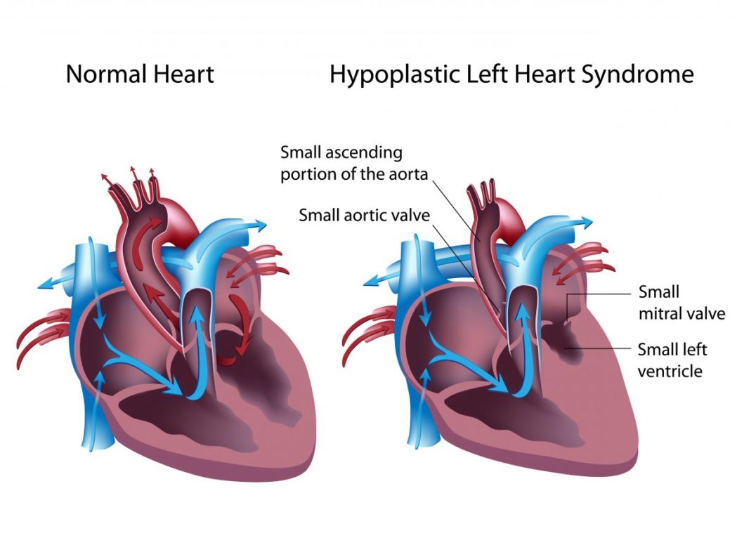 fetal syndromes hypoplastic left heart syndrome