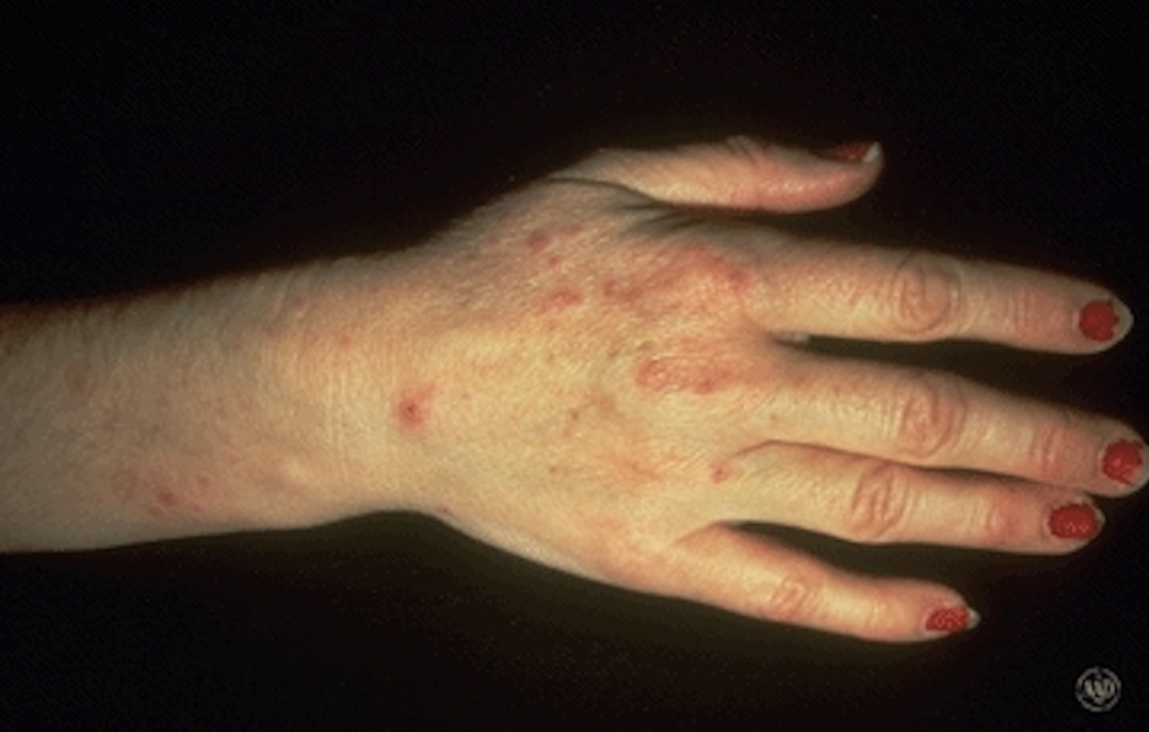 Handwashing-hand-eczema