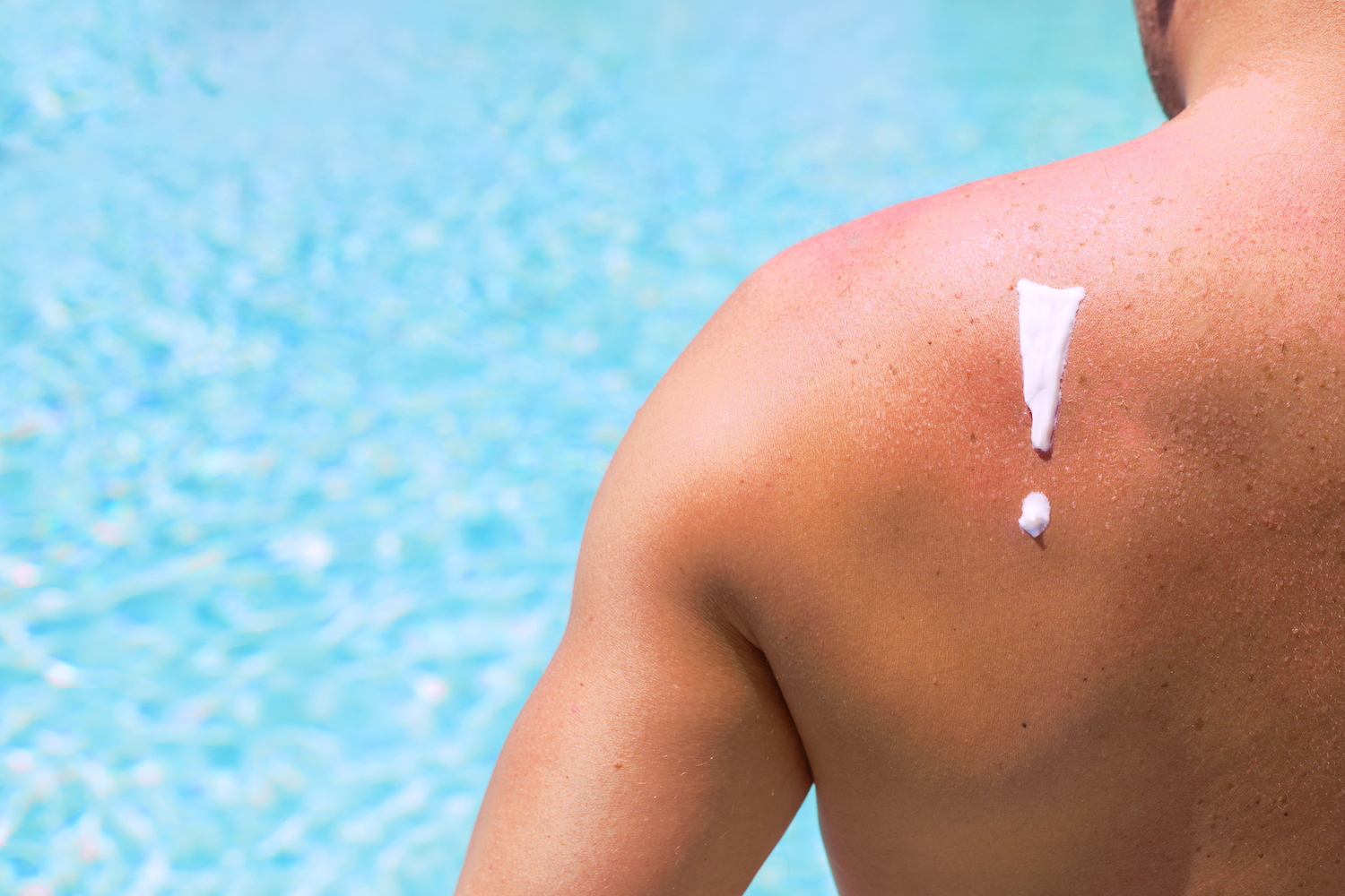 Man with sunburn by swimming pool 1500 x 1000