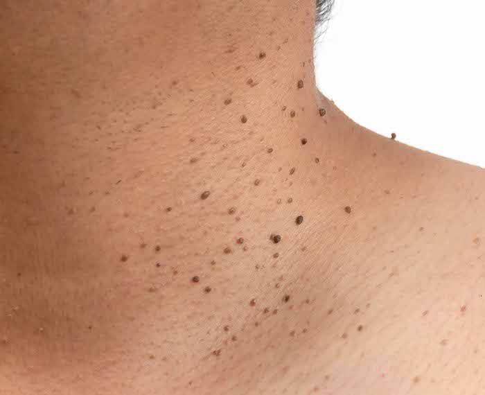 multiple skin tags around the neck