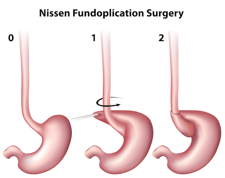 Nissen Fundoplication Surgery graphic 750 x 594