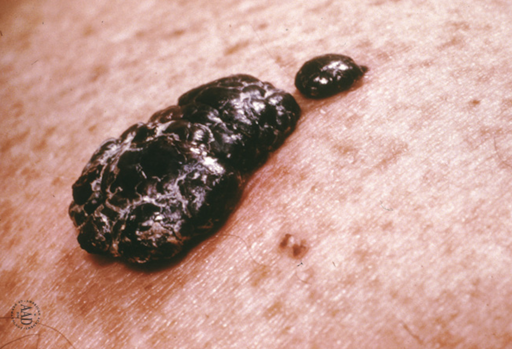 Nodular melanoma 1046 x 712
