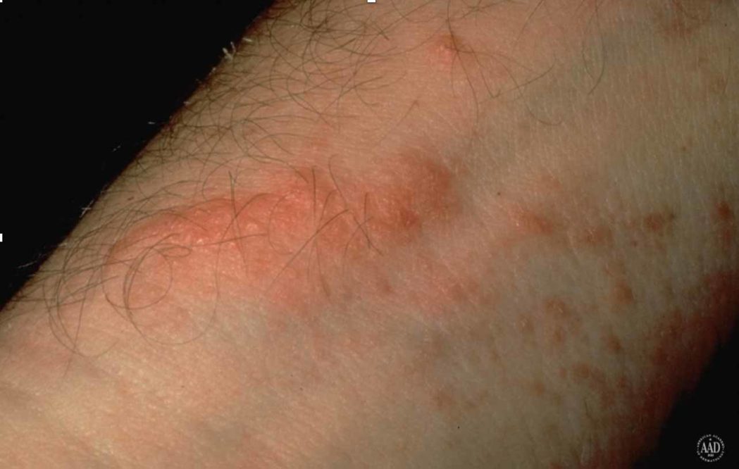 poison ivy dermatitis