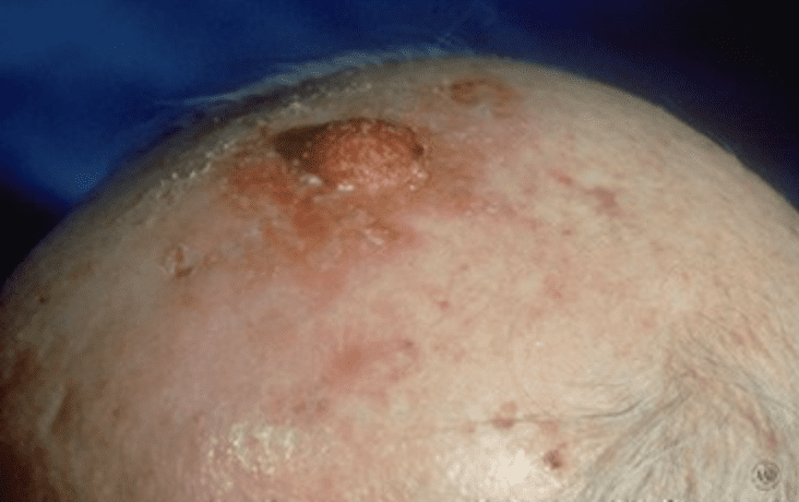 wart-like squamous cell carcinoma 