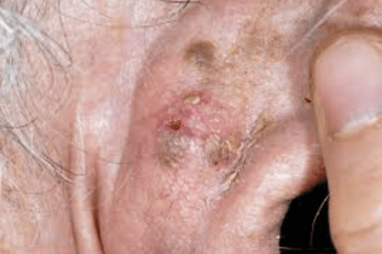 Squamous cell carcinoma on earlobe