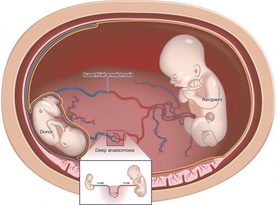 fetal syndromes TTTS