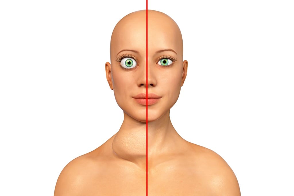 thyroid eye disease graphic