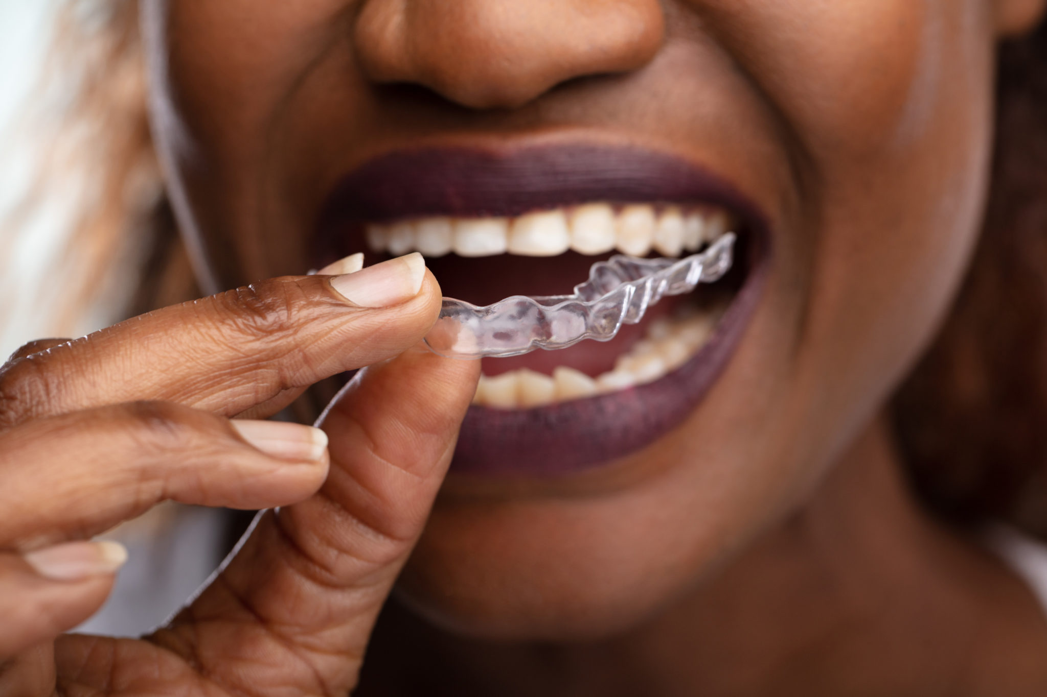 teledentistry invisible aligners