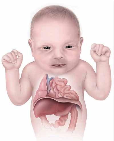 fetal syndromes congenital diaphragmatic hernia