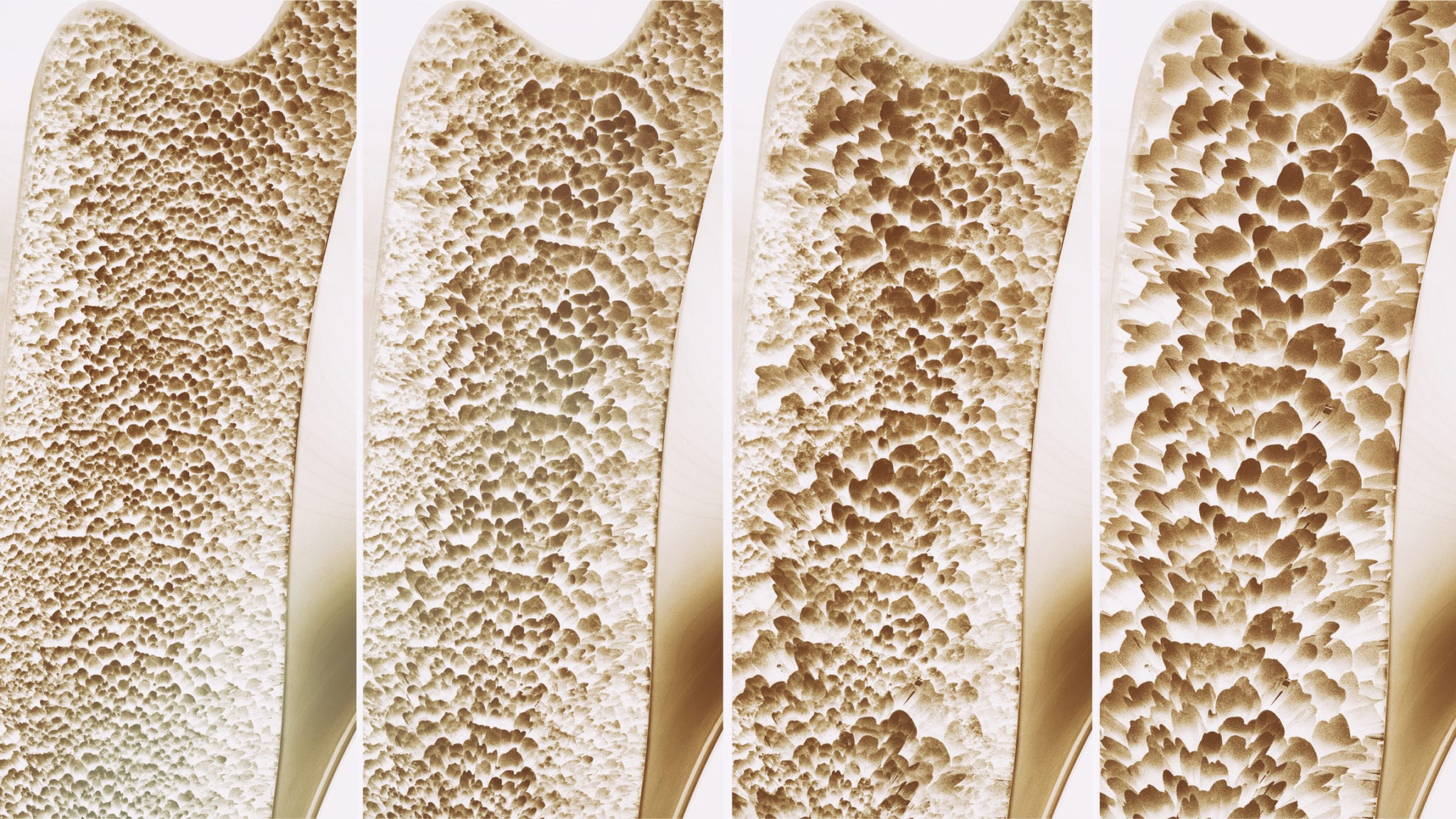 close up osteoporotic bones, risk factor for (fragility fractures)
