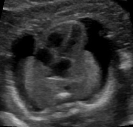 fetal syndromes pleural fluid fetal hydrops